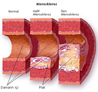 Kalp Damar Hastalklar Nedir? Atheroskleroz