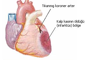 Kalp Krizi Tanımı ve Nedenleri  Antmi