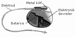 KALP PL (PACEMAKER) Pacemakerparca