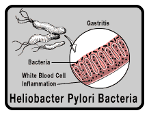 القرحة الهضمية و بكتيريا الحلزوينية Hp