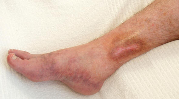 اعراض الجلطات الدموية في الساق. Posthrombotic-pigmentation