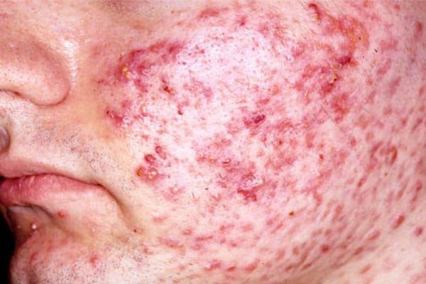 Gli atei che valore danno agli esseri? Acne-vulgaris