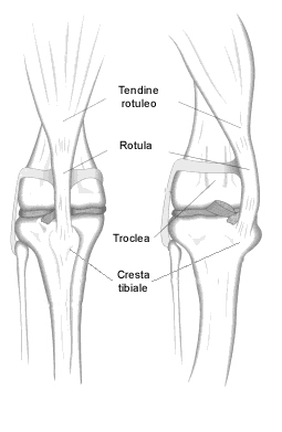 lussazione della rotula TPC05