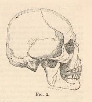  The Adena Giant Revealed: Profile of Prehistoric Mound Builders Brachycephalic-Beaker-skull