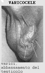 دوالي الحبل المنوي (الخصيتين) والعقم عند الذكور Varicocele