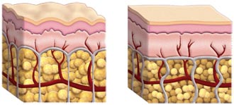 La cellulite : pourquoi et quelles solutions ? Eliminer-cellulite