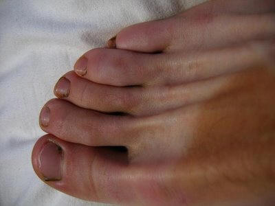 كل شيء عن النقرس (gout) Gout.h3