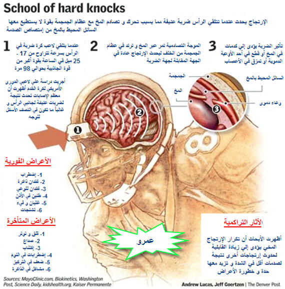 تعرف علي الإرتجاج المخي بصورة واحدة فقط !!! Conc_1