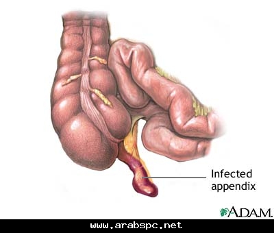 التهاب الزائدة الدودية‏ 2c2ca5fe4b