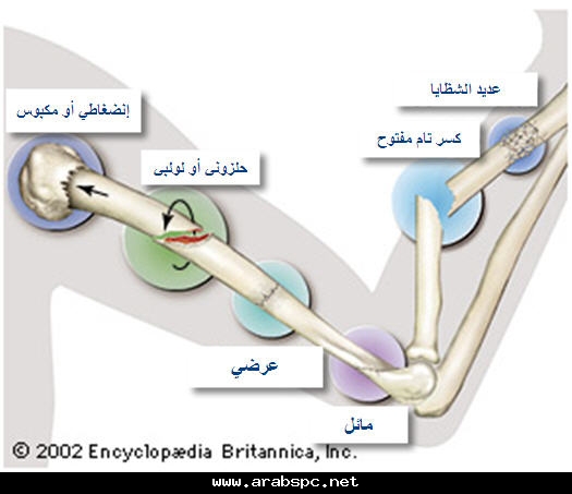 شرح ميسر لأنواع كسور العظام الطولية 67f1d30adb