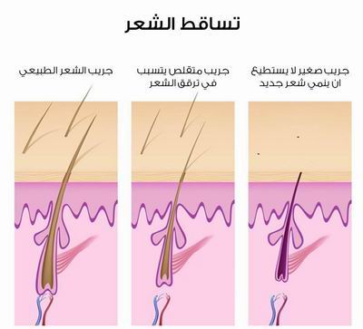 اسباب تساقط الشعر  11-2