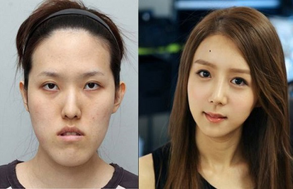  صور غير معقولة لكوريين قبل وبعد عمليات التجميل Korean-before-after-14