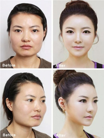  صور غير معقولة لكوريين قبل وبعد عمليات التجميل Korean-before-after-2