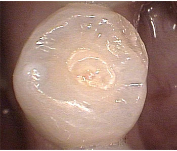 اندلاق الأسنان( حدبة تالون)... Dens Evaginatus Topacio1