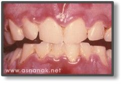 التهابات اللثة عند الأطفال  Gingivitis in children  ChildrenPerio8