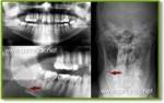 تشخيص الشعاعي لكسور الفك السفلي  Radiographic diagnosis of fractures of the lower jaw 0