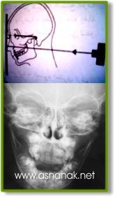 تشخيص الشعاعي لكسور الفك السفلي  Radiographic diagnosis of fractures of the lower jaw 11