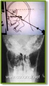 تشخيص الشعاعي لكسور الفك السفلي  Radiographic diagnosis of fractures of the lower jaw 12