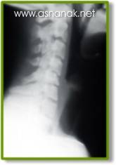 تشخيص الشعاعي لكسور الفك السفلي  Radiographic diagnosis of fractures of the lower jaw 2