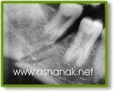 تشخيص الشعاعي لكسور الفك السفلي  Radiographic diagnosis of fractures of the lower jaw 3