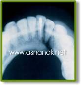 تشخيص الشعاعي لكسور الفك السفلي  Radiographic diagnosis of fractures of the lower jaw 4