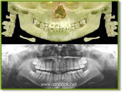 تشخيص الشعاعي لكسور الفك السفلي  Radiographic diagnosis of fractures of the lower jaw 5