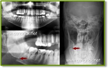 تشخيص الشعاعي لكسور الفك السفلي  Radiographic diagnosis of fractures of the lower jaw 6