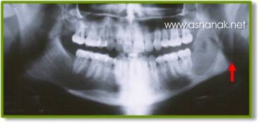 تشخيص الشعاعي لكسور الفك السفلي  Radiographic diagnosis of fractures of the lower jaw 7