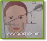 تشخيص الشعاعي لكسور الفك السفلي  Radiographic diagnosis of fractures of the lower jaw 9