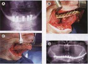 الشبكات الممتصة كنظام مفيد في إعادة بناء كسورالفك السفلي الضامر Absorbed networks as a system is useful in the reconstruction of the lower Xworalvk atrophic Image006