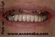زراعة الاسنان Asnan-619
