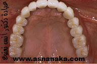 زراعة الاسنان Asnan-621