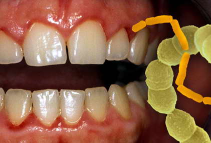 أمراض الشرايين هل لها علاقة بالأسنان 12marad2