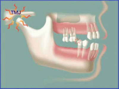 الصداع المبهم قد يكون بسبب أسنانك ولثتك Suda3_alasnan5