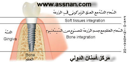 زرعات أسناني تهتز ما هو السبب ؟ Zirconimplant-m