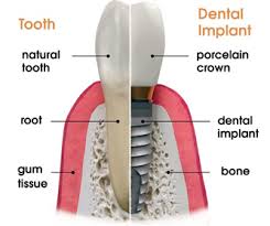 أسباب زراعة الأسنان وكيفيتها Zirconimplant-m1