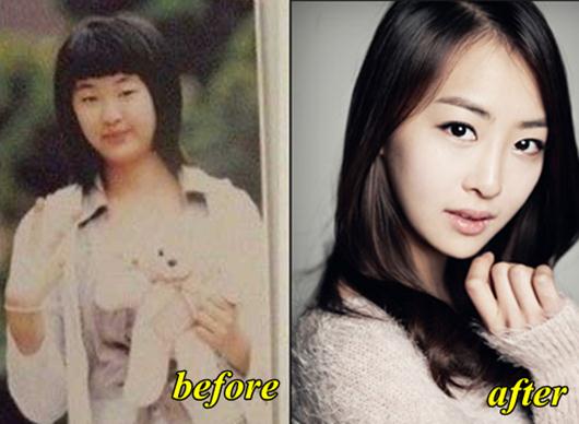 Sistar(씨스타) - Page 4 Sistar-Dasom-plastic-surgery-before-and-after-Photos