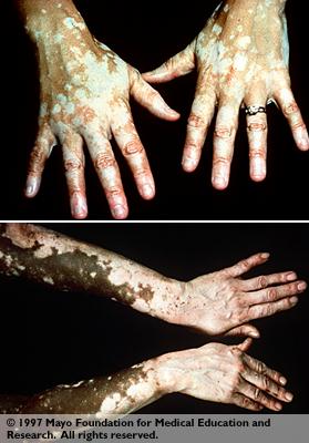 الموسوعة الطبية المتكاملة Vitiligo