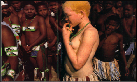 اسباب اختلاف الوان الشعوب Albino