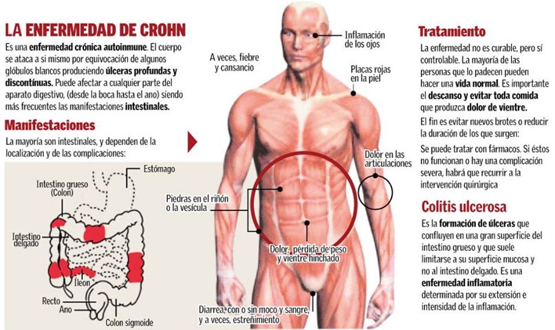 Los casos de enfermedad de Crohn y colitis ulcerosa en menores de 18 años han aumentado un 200% en los últimos años Crohn