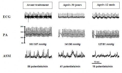 Traiter une HTA résistante par dénervation rénale Denervation-renale-2-499x301