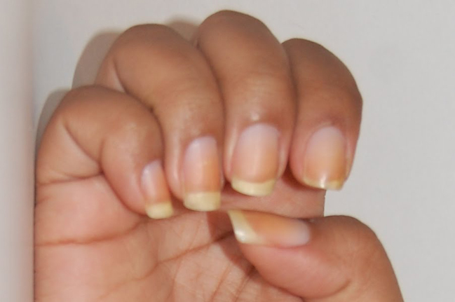 YELLOW NAILS? - Always check other nail features of the hand, like: the cuticles & lunula! DSC_0003-001