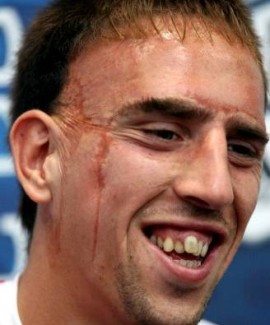 El Madrid no tiene claro si Ribery es un fichaje prioritario Ribery%20dientes1_83_ampliada