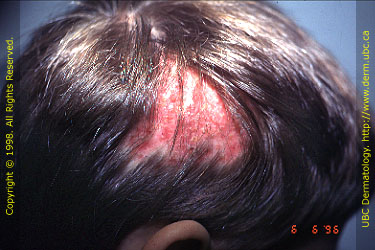 tinea capitis مرض جلدي 04