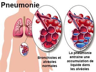 La pneumonie Image_3554_m