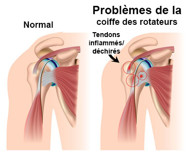 rupture de la coiffe des rotateurs (épaule) - Page 2 Image_4126