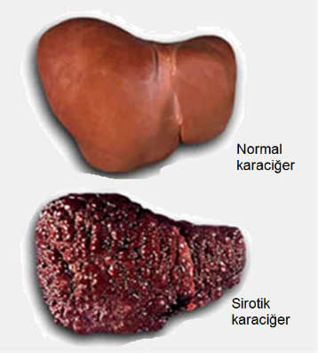 25 ARALIK 2016 BULMACASI SAYI : 1604 - Sayfa 2 Cirrhosis