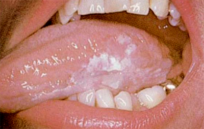 معلومات هامة Oralcancer6