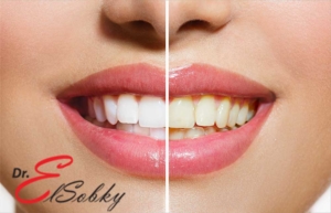 افضل اجهزة تبييض الاسنان بالليزر Laser-teeth-whitening-300x193