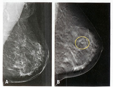 Ayuda necesito foto (the serious kind of help) - Página 2 Sharma-obesity-mammography